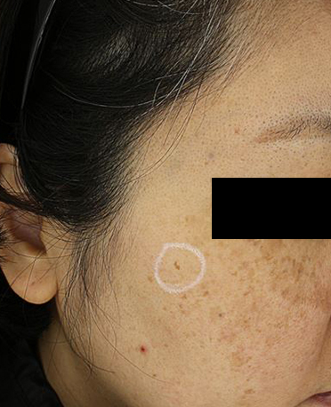 흑자 리팟레이저 시술  시술 전 사진