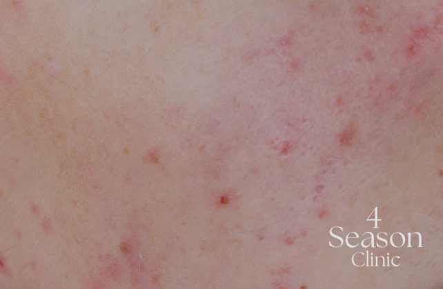 포시즌의원 여드름 중증도