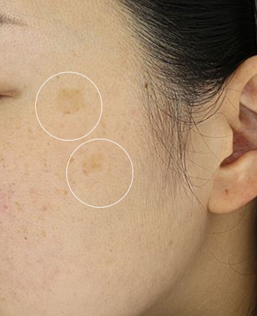 흑자 리팟레이저 시술  시술 전 사진