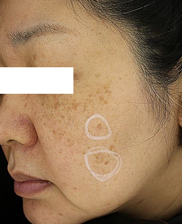 흑자 리팟레이저 시술  시술 전 사진