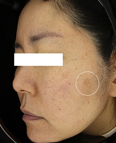 흑자 리팟레이저 시술 시술 전 사진