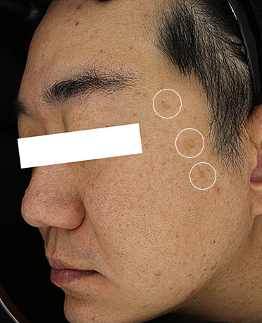 흑자 리팟레이저 시술 시술 전 사진