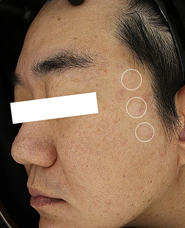 흑자 리팟레이저 시술 시술 후 사진