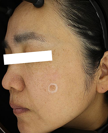 흑자 리팟레이저 시술 시술 전 사진