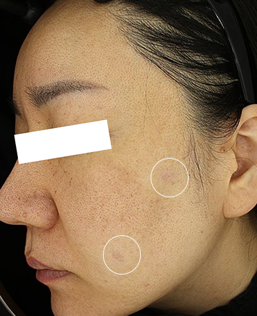 흑자 리팟레이저 시술 시술 후 사진