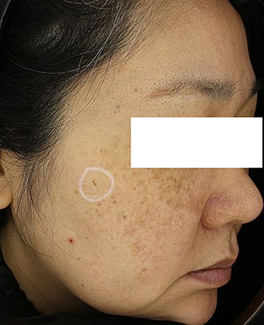 흑자 리팟레이저 시술 시술 전 사진